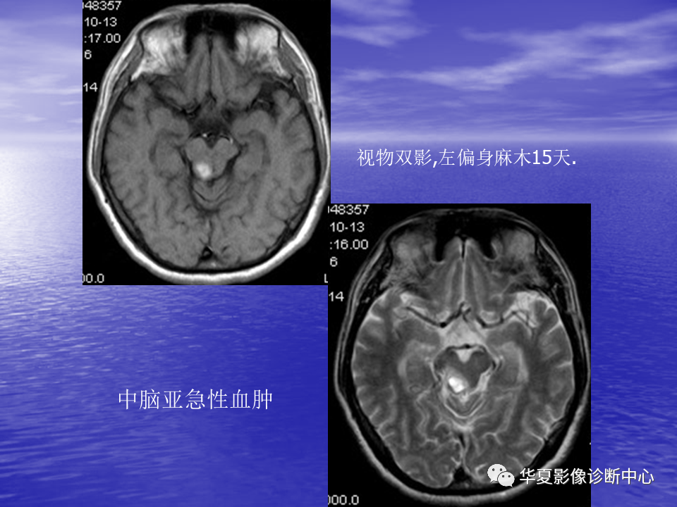 影像PPT - 【PPT】脑血管病变的MRI-22