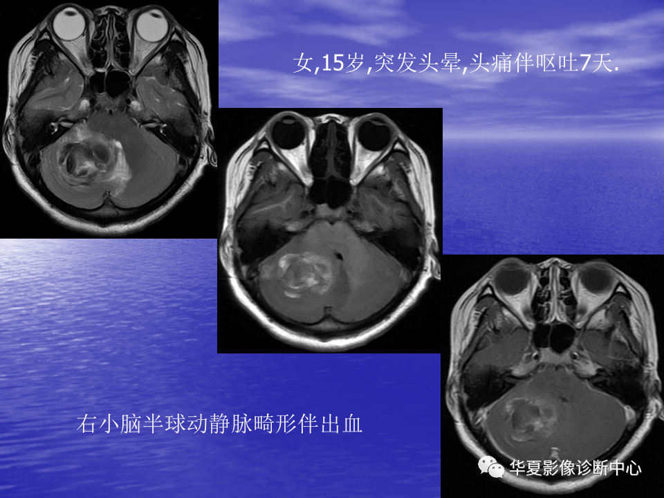影像PPT - 【PPT】脑血管病变的MRI-23