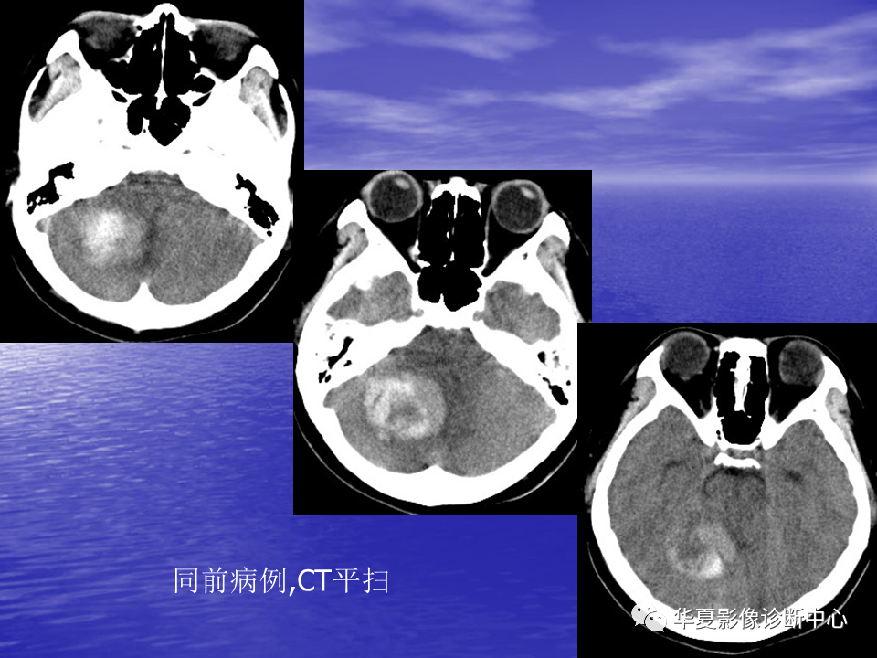 影像PPT - 【PPT】脑血管病变的MRI-24