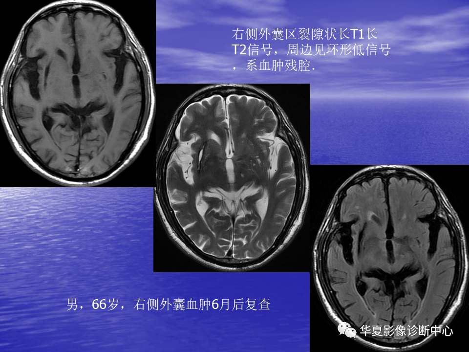 影像PPT - 【PPT】脑血管病变的MRI-25