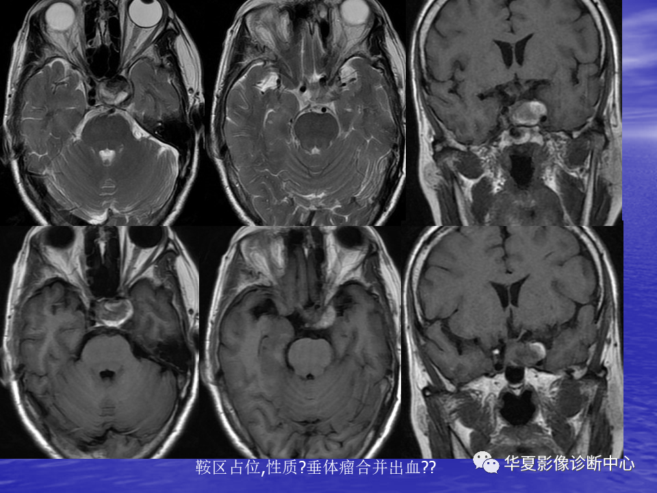 影像PPT - 【PPT】脑血管病变的MRI-29
