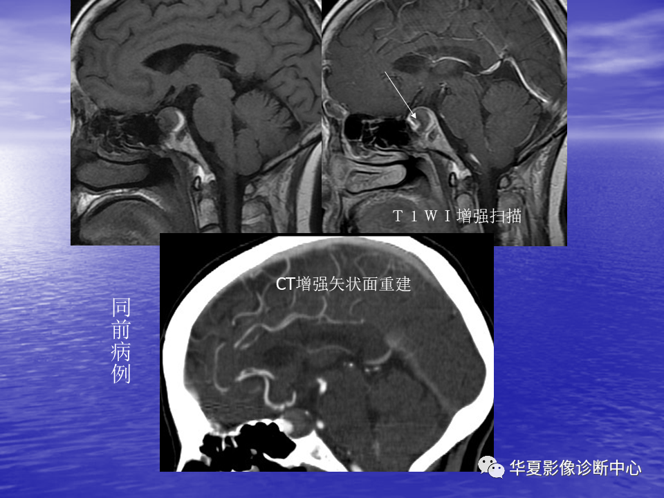 影像PPT - 【PPT】脑血管病变的MRI-30