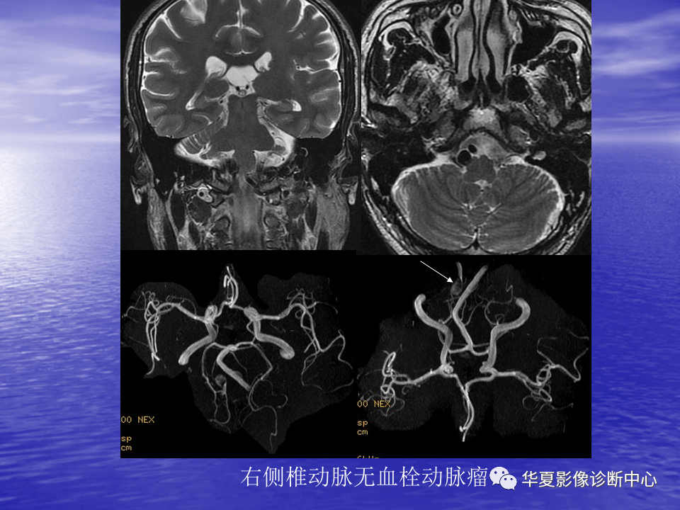影像PPT - 【PPT】脑血管病变的MRI-32