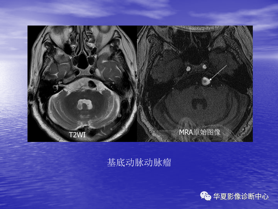 影像PPT - 【PPT】脑血管病变的MRI-33