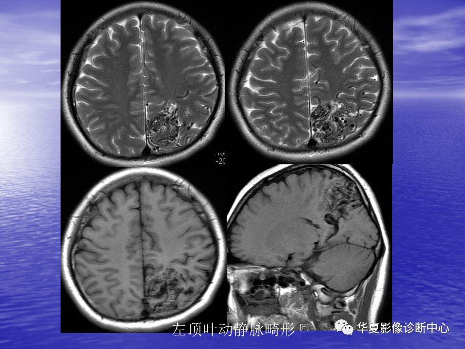 影像PPT - 【PPT】脑血管病变的MRI-35
