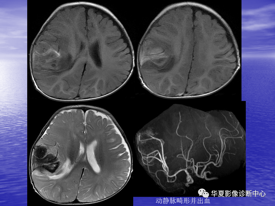 影像PPT - 【PPT】脑血管病变的MRI-36