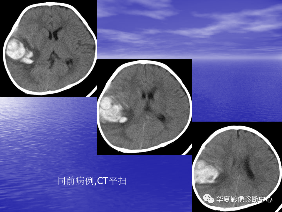 影像PPT - 【PPT】脑血管病变的MRI-37