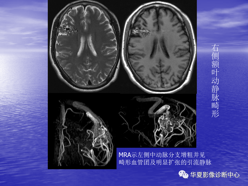 影像PPT - 【PPT】脑血管病变的MRI-38