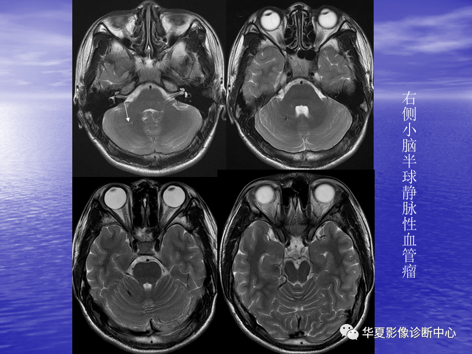 影像PPT - 【PPT】脑血管病变的MRI-41
