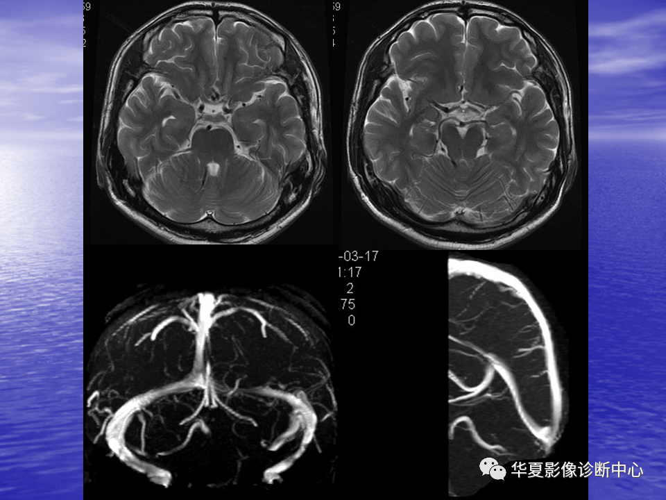 影像PPT - 【PPT】脑血管病变的MRI-42