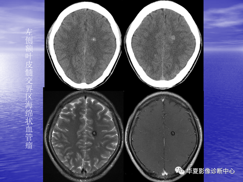 影像PPT - 【PPT】脑血管病变的MRI-44