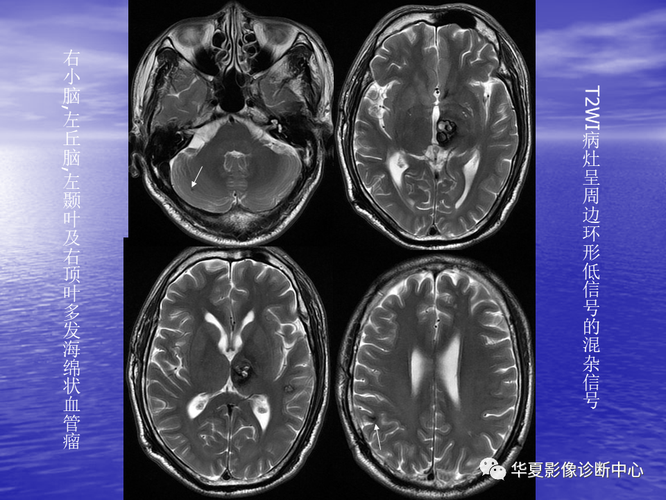 影像PPT - 【PPT】脑血管病变的MRI-45