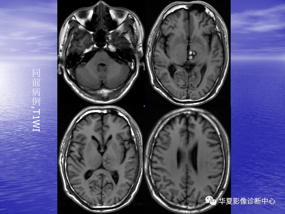 影像PPT - 【PPT】脑血管病变的MRI-46