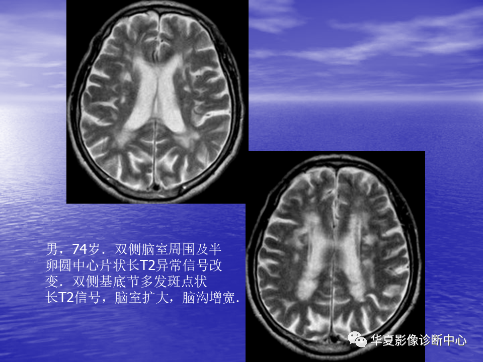 影像PPT - 【PPT】脑血管病变的MRI-49