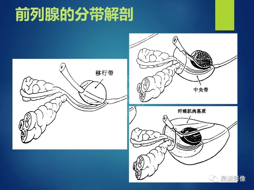 影像PPT - 【PPT】前列腺癌的磁共振成像诊断-4