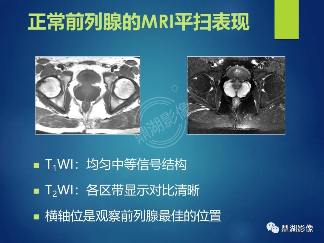 影像PPT - 【PPT】前列腺癌的磁共振成像诊断-7