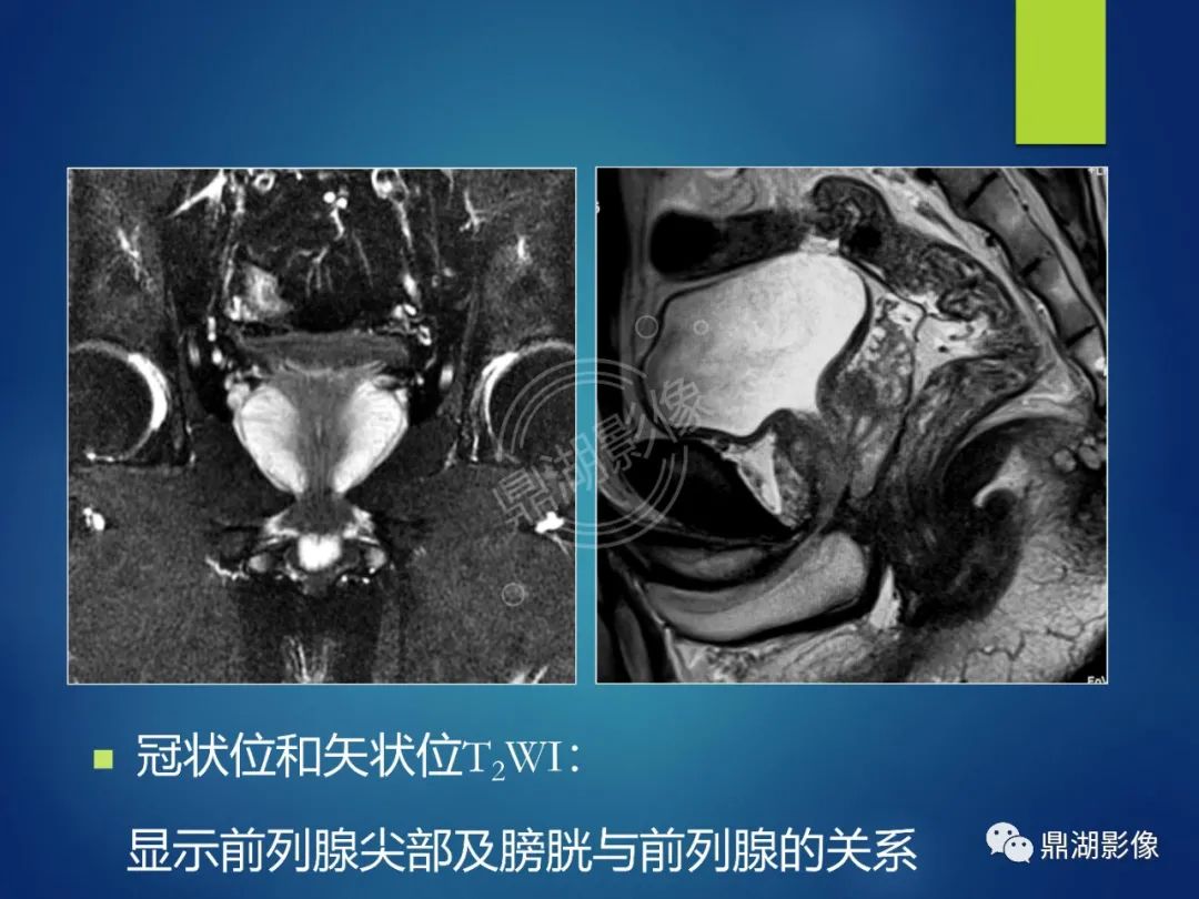 影像PPT - 【PPT】前列腺癌的磁共振成像诊断-8