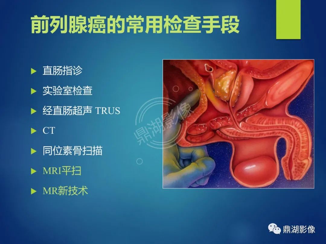 影像PPT - 【PPT】前列腺癌的磁共振成像诊断-11