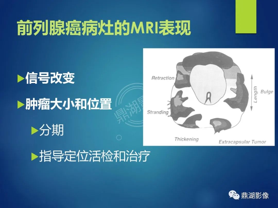 影像PPT - 【PPT】前列腺癌的磁共振成像诊断-20