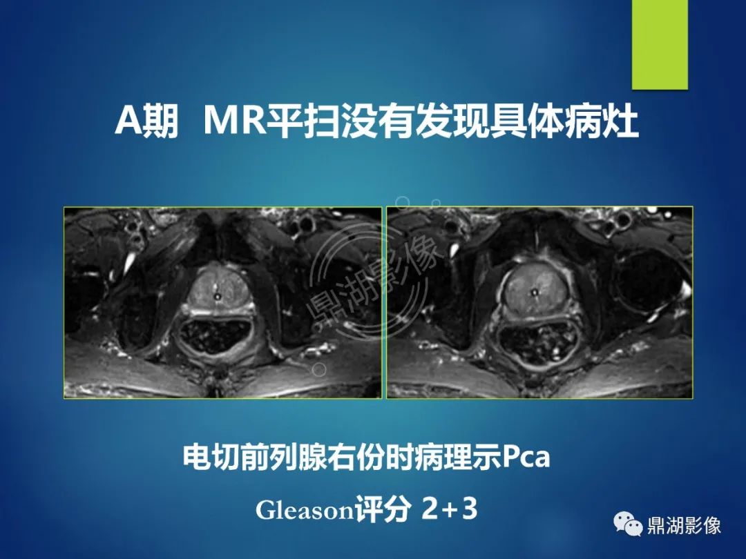 影像PPT - 【PPT】前列腺癌的磁共振成像诊断-21