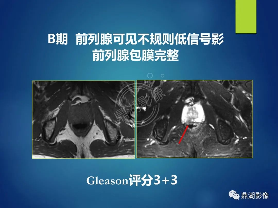 影像PPT - 【PPT】前列腺癌的磁共振成像诊断-22