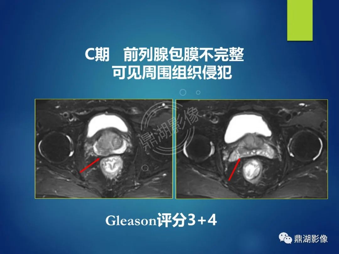 影像PPT - 【PPT】前列腺癌的磁共振成像诊断-23