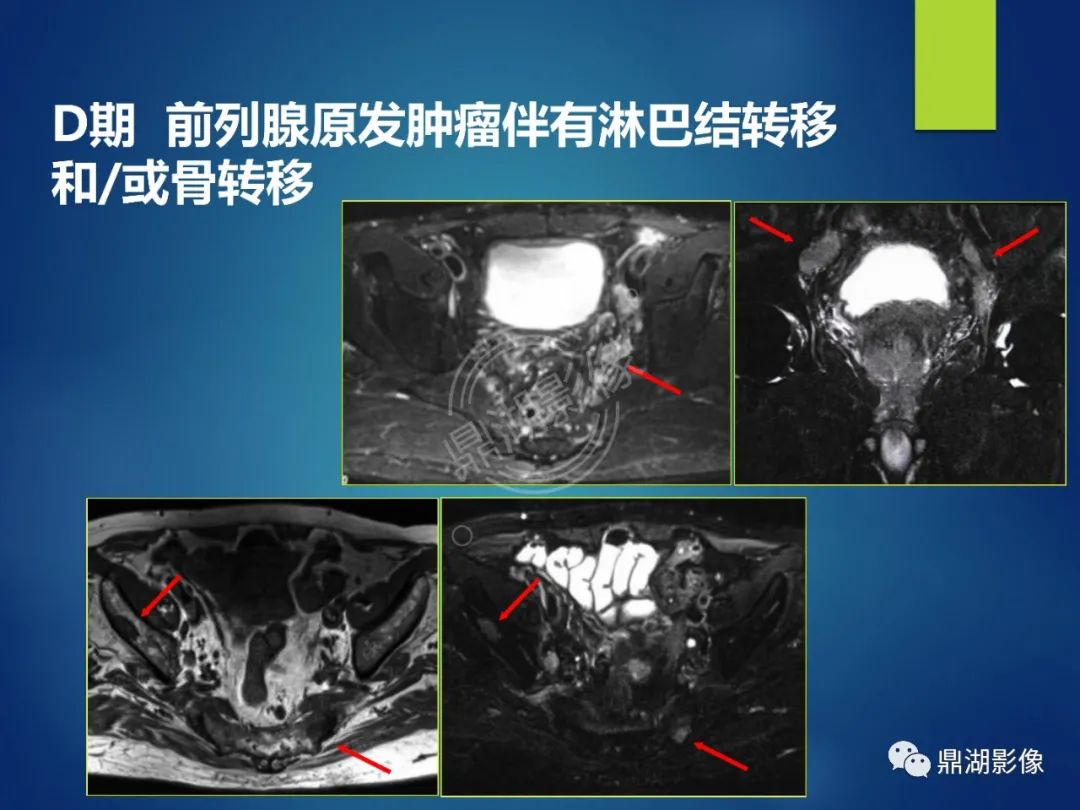 影像PPT - 【PPT】前列腺癌的磁共振成像诊断-24