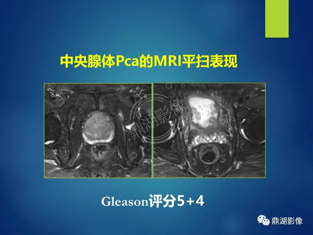 影像PPT - 【PPT】前列腺癌的磁共振成像诊断-25