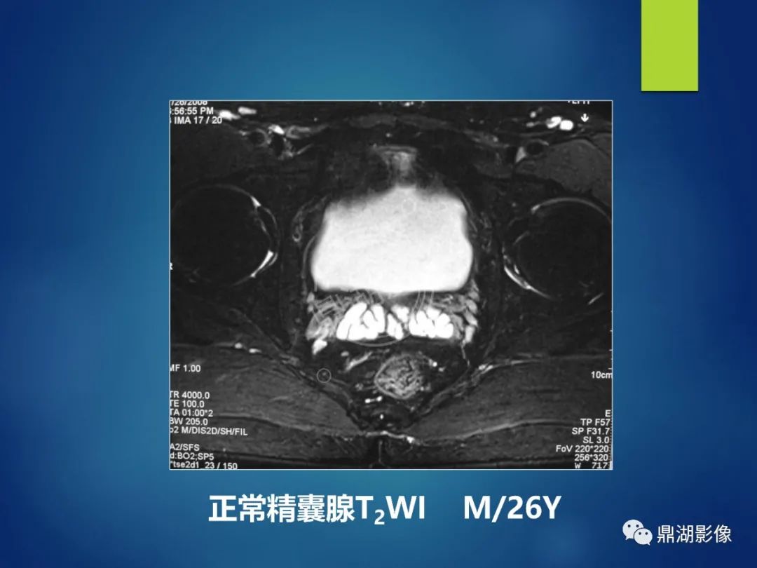 影像PPT - 【PPT】前列腺癌的磁共振成像诊断-33