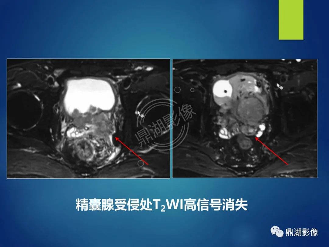 影像PPT - 【PPT】前列腺癌的磁共振成像诊断-34
