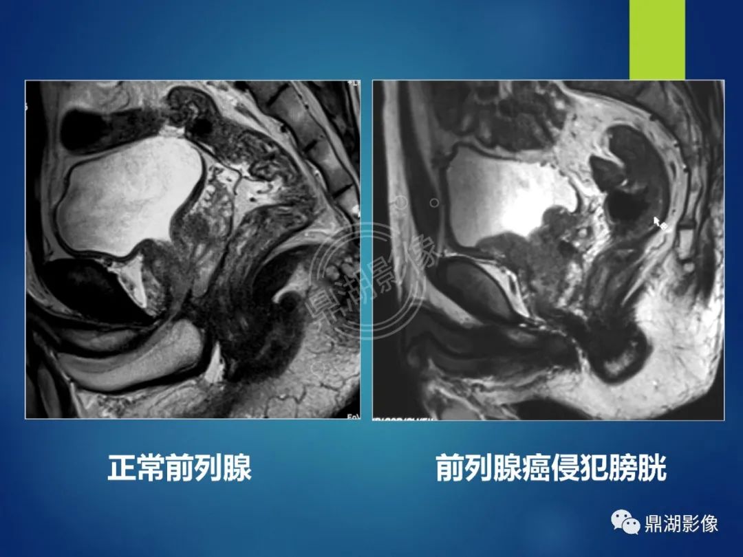 影像PPT - 【PPT】前列腺癌的磁共振成像诊断-36