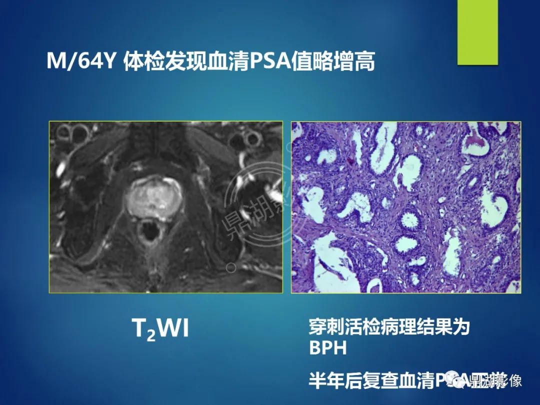 影像PPT - 【PPT】前列腺癌的磁共振成像诊断-46