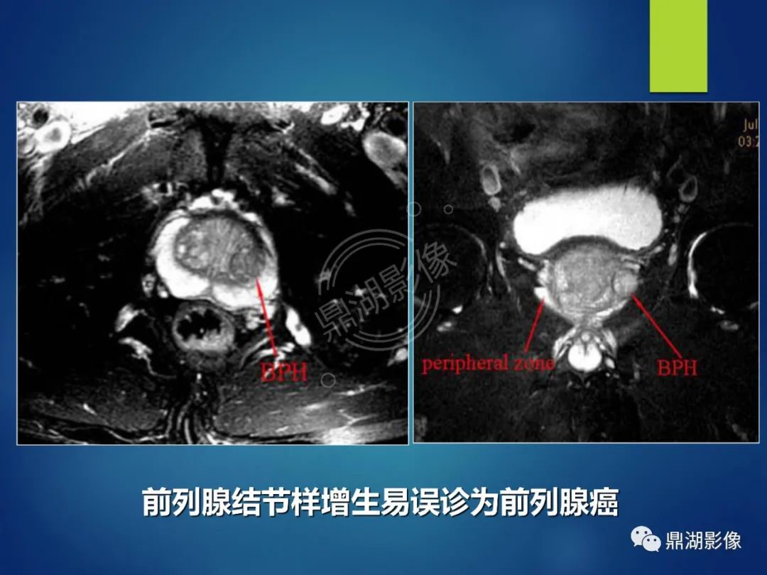 影像PPT - 【PPT】前列腺癌的磁共振成像诊断-50