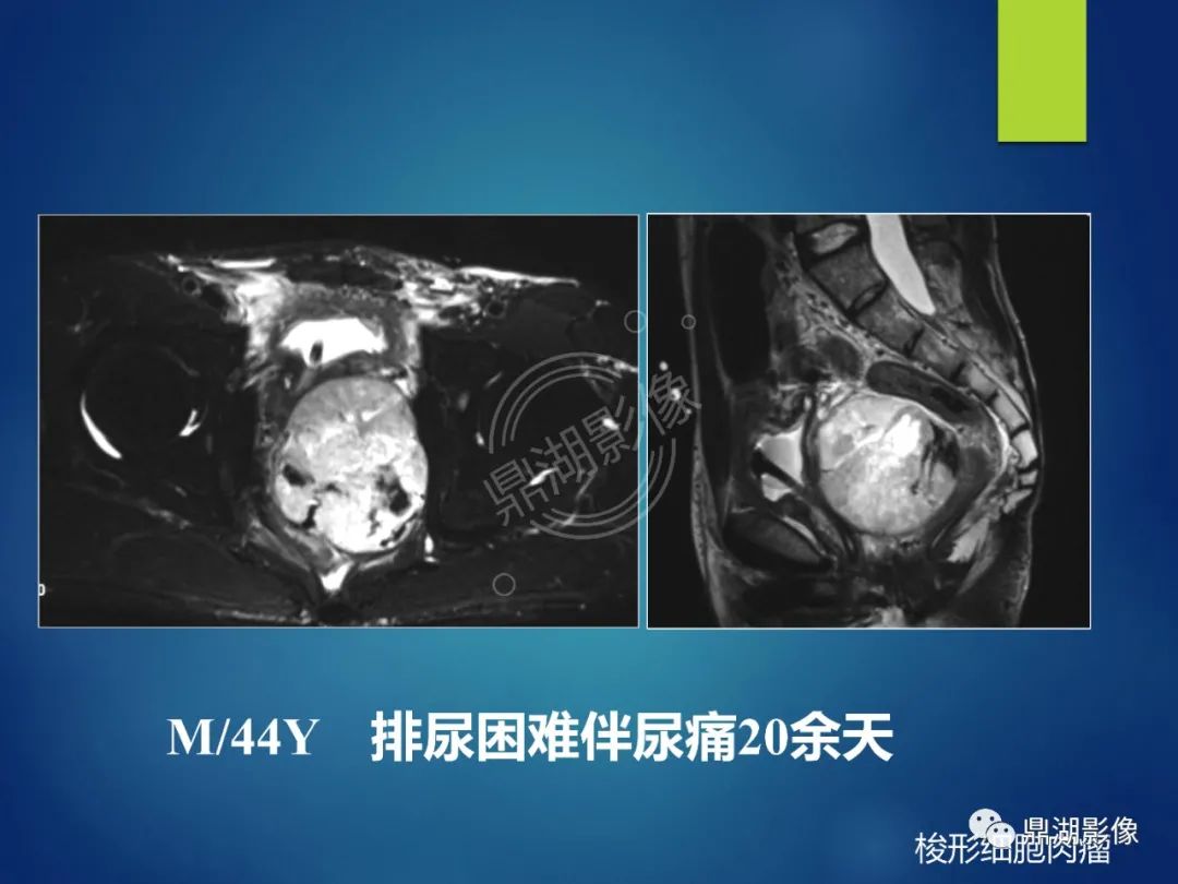 影像PPT - 【PPT】前列腺癌的磁共振成像诊断-52