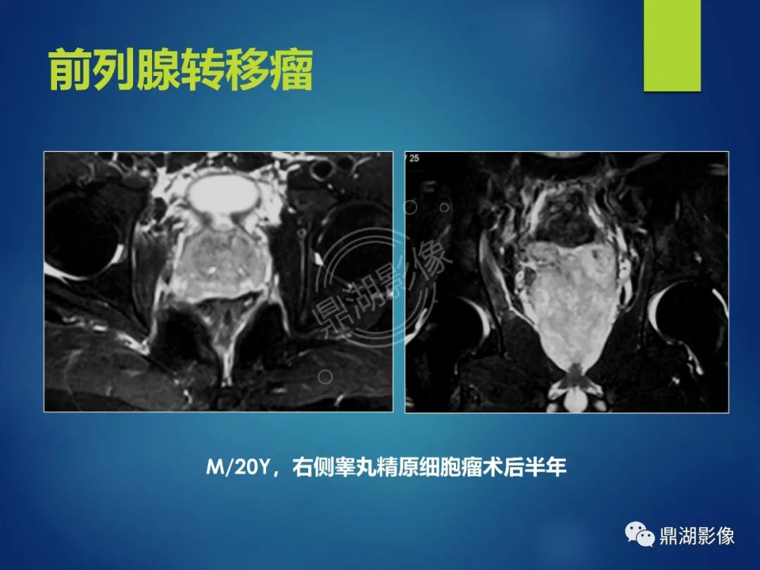 影像PPT - 【PPT】前列腺癌的磁共振成像诊断-53