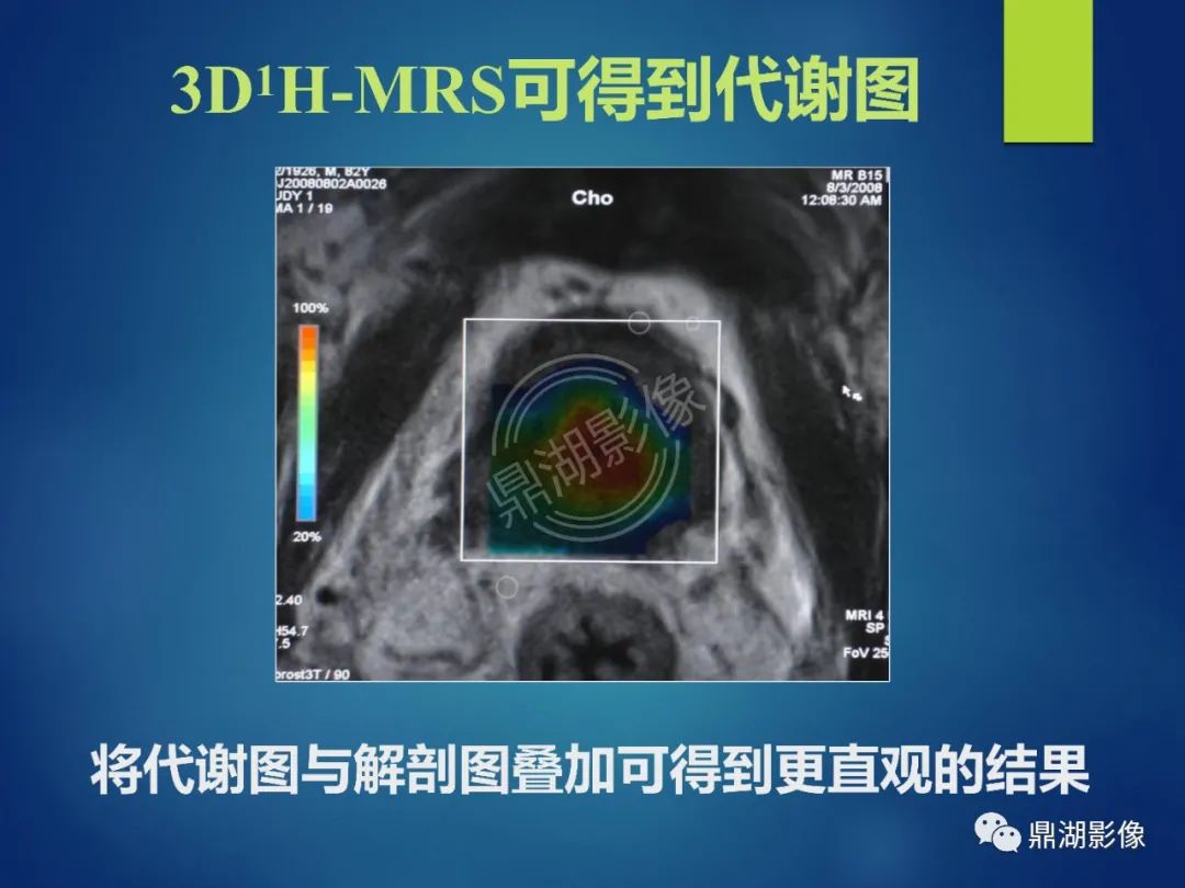 影像PPT - 【PPT】前列腺癌的磁共振成像诊断-60