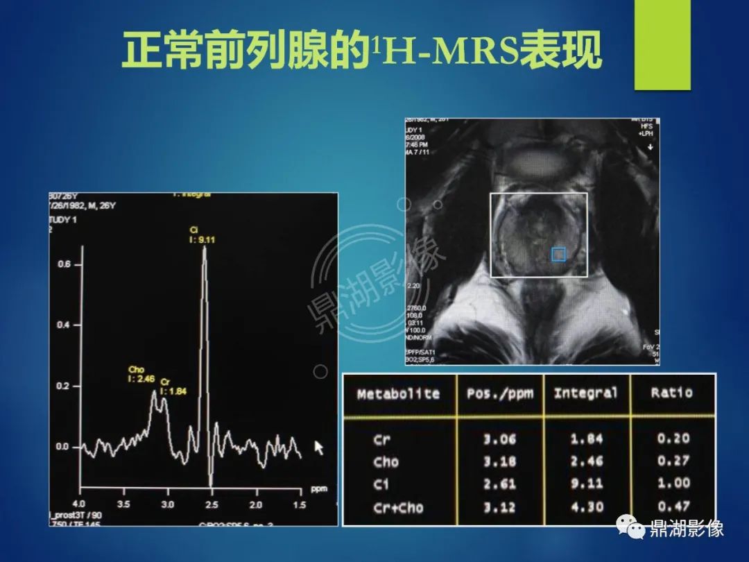 影像PPT - 【PPT】前列腺癌的磁共振成像诊断-61