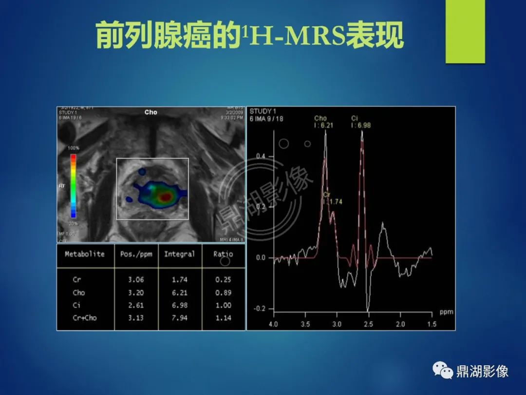 影像PPT - 【PPT】前列腺癌的磁共振成像诊断-62
