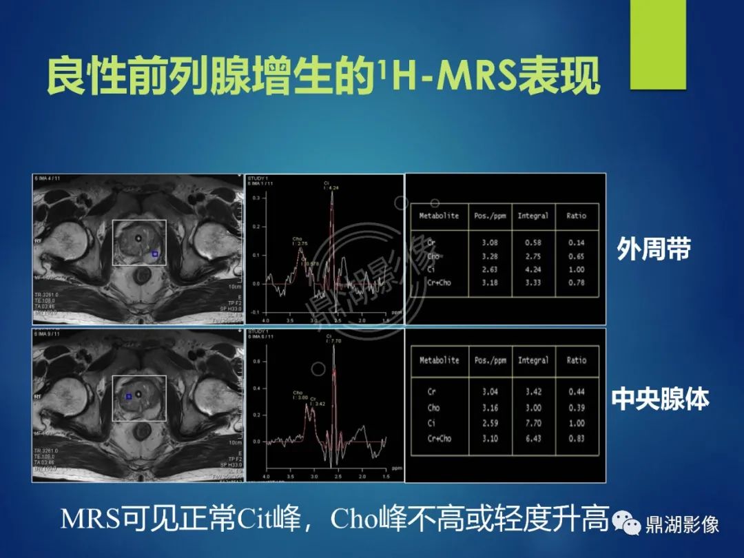 影像PPT - 【PPT】前列腺癌的磁共振成像诊断-65