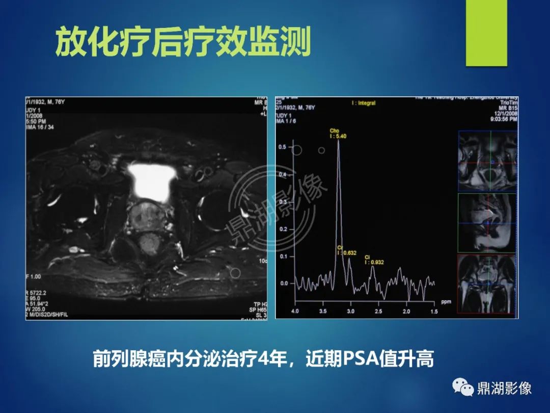 影像PPT - 【PPT】前列腺癌的磁共振成像诊断-66