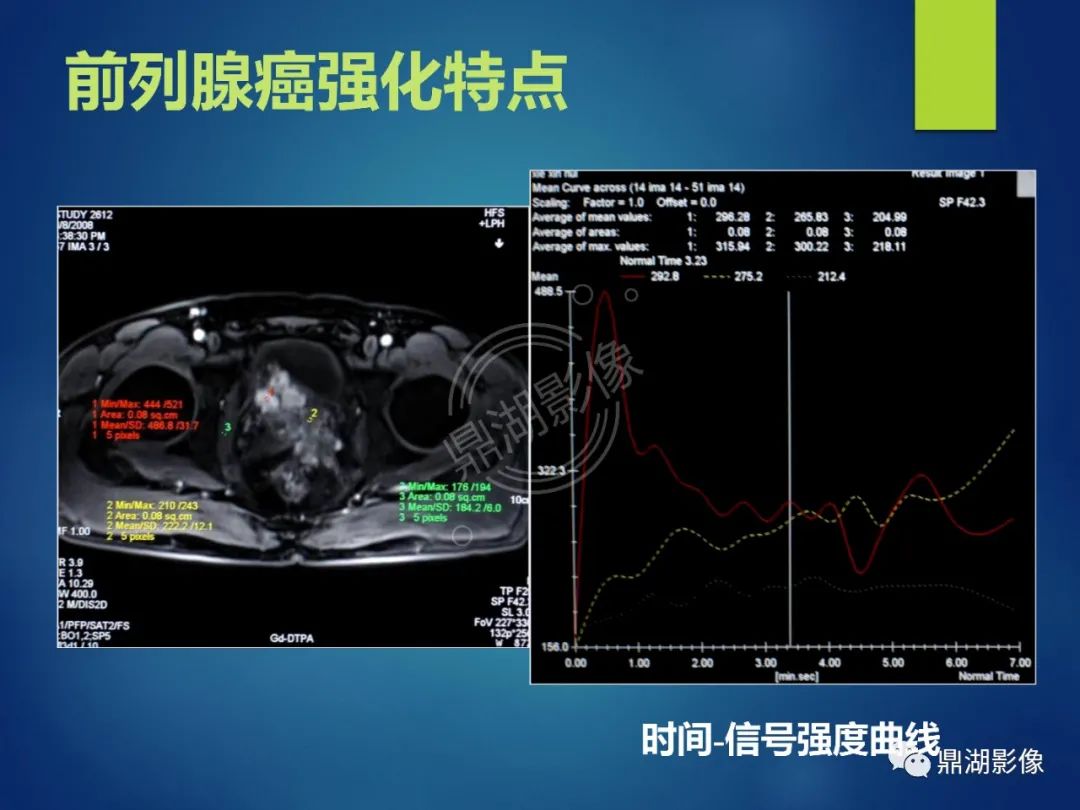 影像PPT - 【PPT】前列腺癌的磁共振成像诊断-70