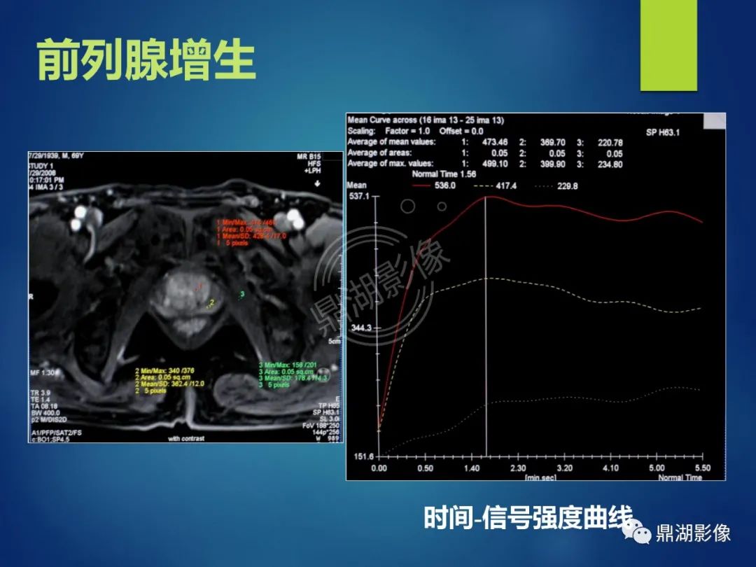 影像PPT - 【PPT】前列腺癌的磁共振成像诊断-71