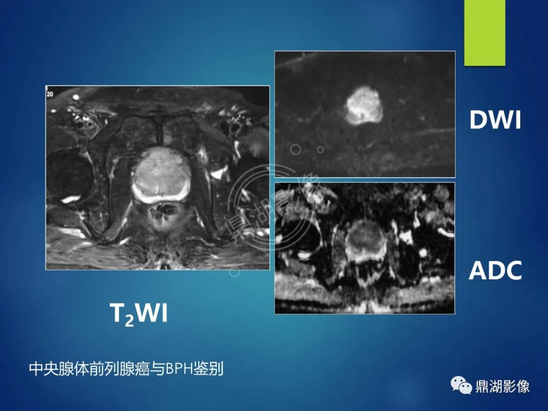影像PPT - 【PPT】前列腺癌的磁共振成像诊断-77