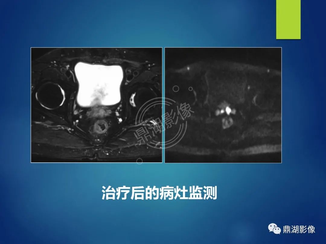 影像PPT - 【PPT】前列腺癌的磁共振成像诊断-78