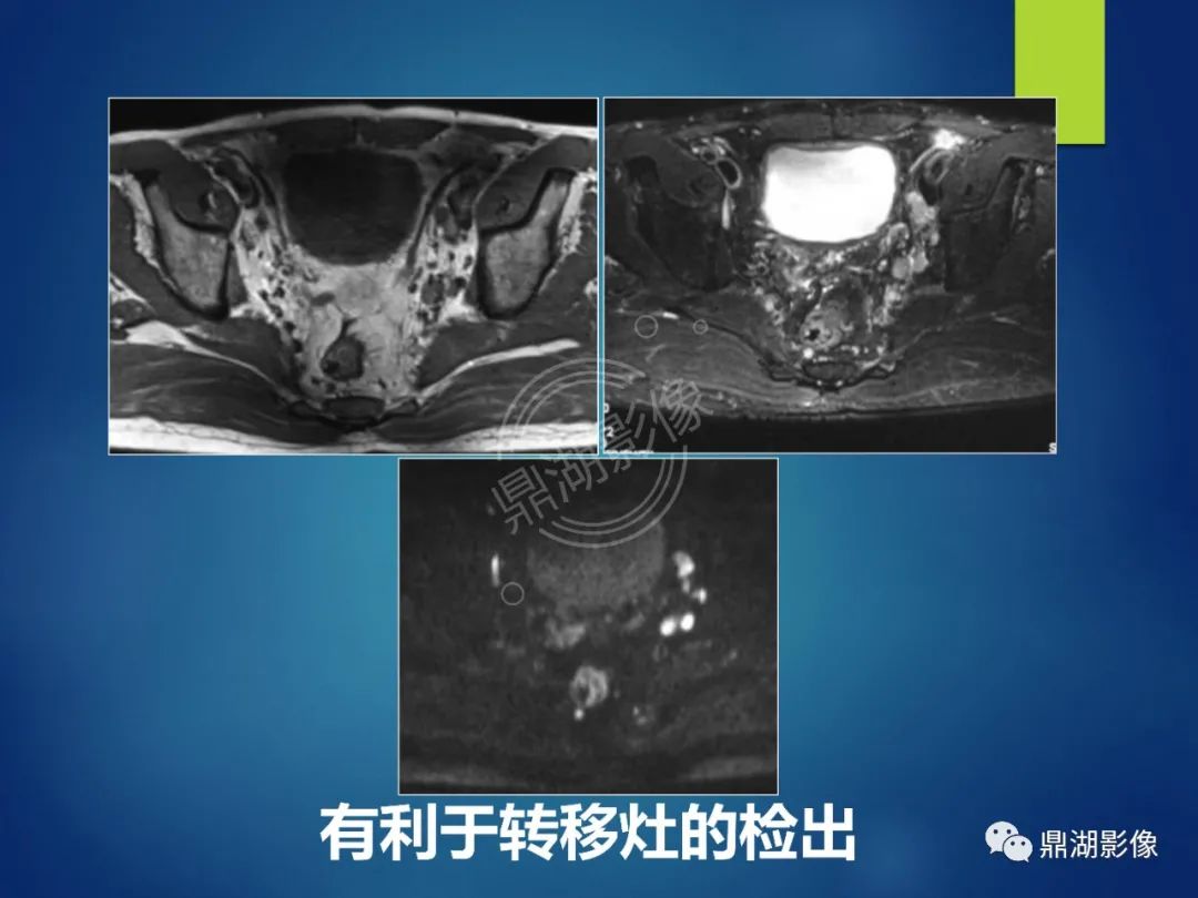 影像PPT - 【PPT】前列腺癌的磁共振成像诊断-79