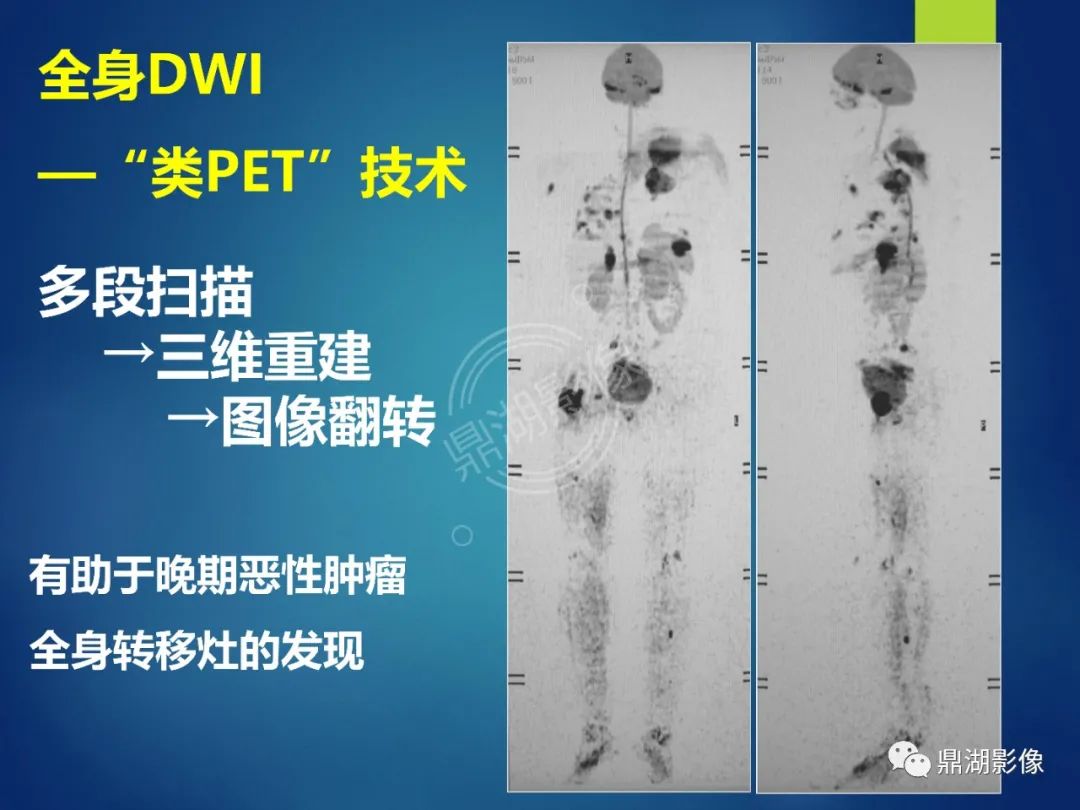 影像PPT - 【PPT】前列腺癌的磁共振成像诊断-80