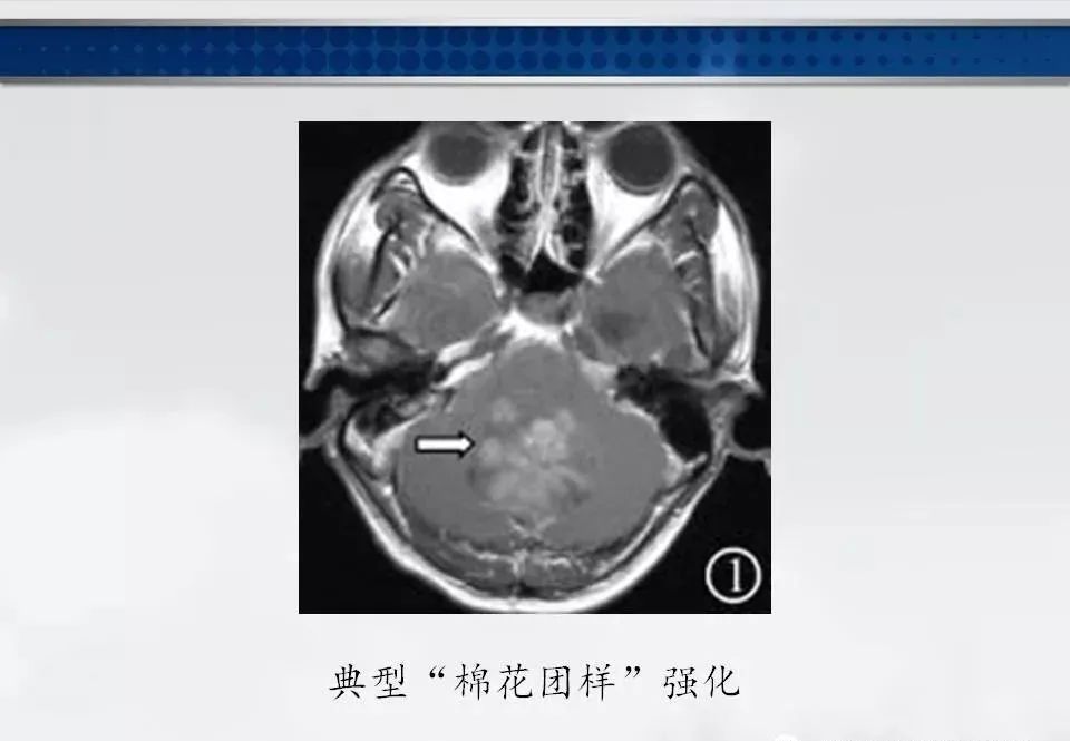 影像PPT - 【PPT】四脑室肿瘤影像诊断与鉴别诊断-5
