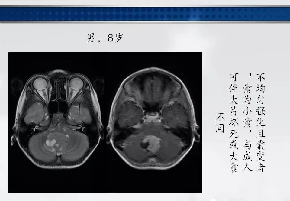 影像PPT - 【PPT】四脑室肿瘤影像诊断与鉴别诊断-6