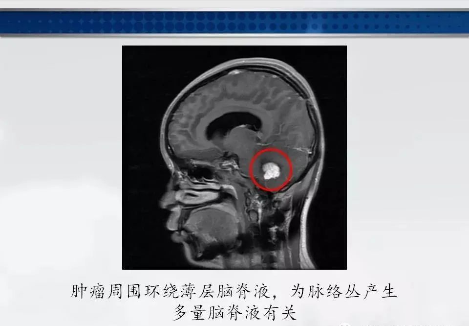 影像PPT - 【PPT】四脑室肿瘤影像诊断与鉴别诊断-8