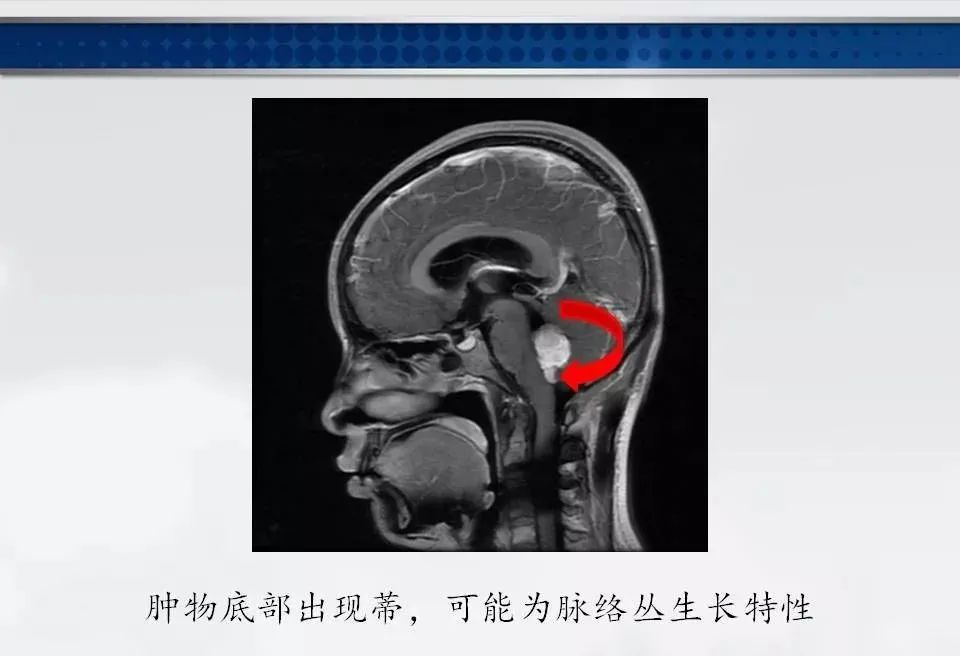 影像PPT - 【PPT】四脑室肿瘤影像诊断与鉴别诊断-9